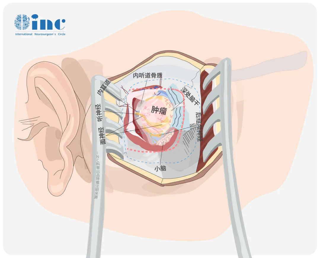 听神经瘤手术如何保听力？两种主流手术入路的对比