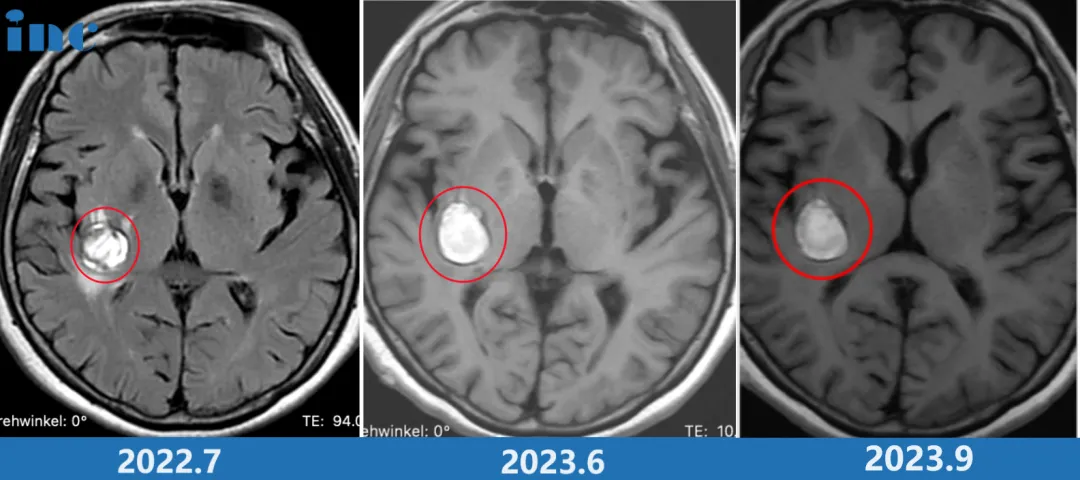 右侧基底节区海绵状血管瘤并发出血