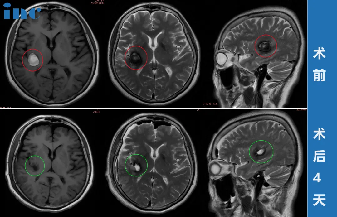 术后核磁显示，海绵状血管瘤已完全切除，且没有新的神经功能损伤。