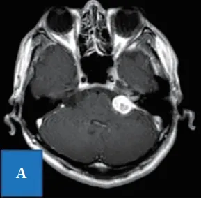 入院时T1-加权项磁共振成像显示，延伸到内听道的桥脑角均匀增强。