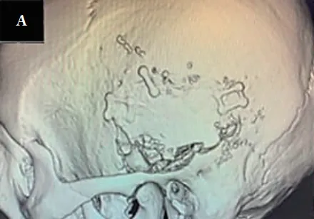 手术中，医生首先做U形皮肤切口，围绕耳廓获取大的带蒂筋膜骨膜，为后续修复做好准备。