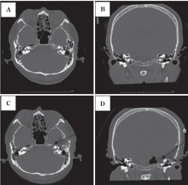 这个案例揭示了伴有颈静脉球高位的听神经瘤患者手术管理的有效策略。