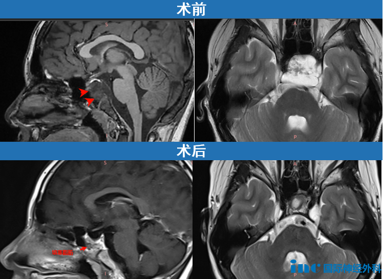 复查发现颅底斜坡区一个33×26×33mm的大肿瘤，已经侵袭左侧海绵窦，导致垂体移位，就连垂体柄都已被推歪。