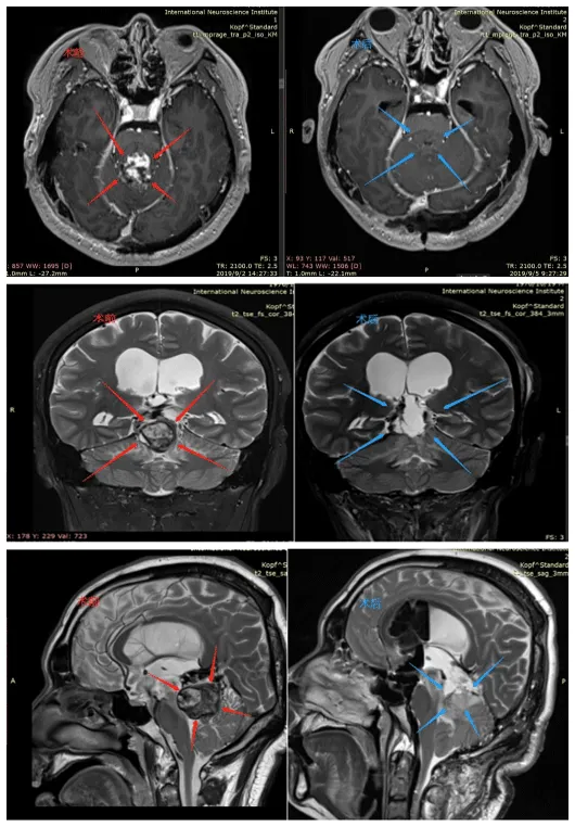 手术结果：巴教授使用小脑幕上、幕下联合的膜髓帆入路来到达肿瘤区域实现全切除。