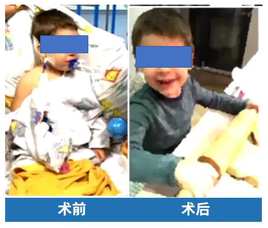 术前术后MRI对比