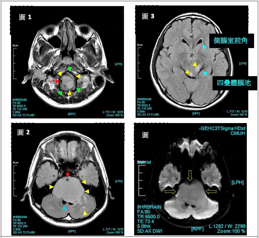 胶质瘤热点答疑|有关手术时机、切除率、并发症、复发