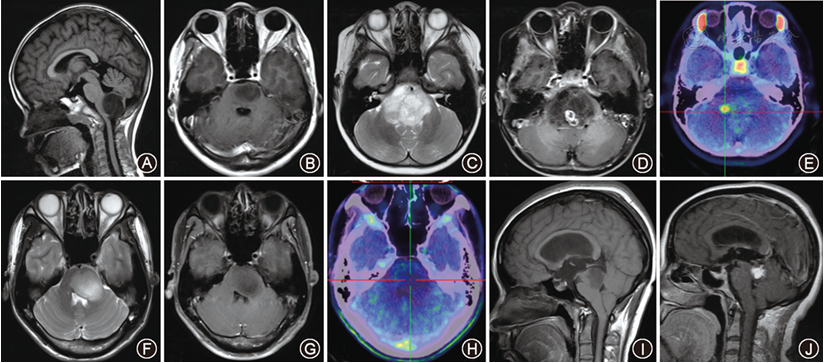 即使孩子的胶质瘤处于功能区也不意味着没有手术希望。手术切除率大多取决于肿瘤的位置和类型。简单来说,基本上有两种类型的胶质瘤,一种是生长在中枢神经组织的局灶性肿瘤(下图B),这意味着肿瘤生长紧凑,而且与正常组织有明确的边界,将有极大可能实现全切。另一种是弥漫性的胶质瘤,它大多散布在大脑或脊髓内,没有清晰的边界(下图F-H)。在这种情况下,一般无法达到很高的切除率。