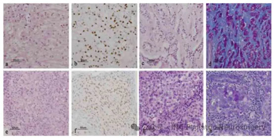 使用MEDLINE 和 Embase 数据库以“chordoma（脊索瘤）”和“pediatric（儿童）”为检索词，筛选英文文献病例系列，相关文献与资料提取由第一及第二作者完成。