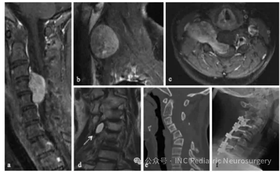 图 2. 患者 2：C3–C5 脊索瘤影像示例 (a) 术前 矢状位T1 加权 MRI（增强 gadolinium）； (b) 术前右侧旁矢状位 T1 加权增强 MRI； (c) 术前水平位 T1 加权增强 MRI； (d) 术后 冠状位T2 加权 MRI，可见囊性残留（箭头）； (e) 术后 2 年 矢状位 CT，可见进行性颈椎后凸侧弯（kyphoscoliosis）； (f) 术后 C3–T1 内固定融合侧位 X 线片。