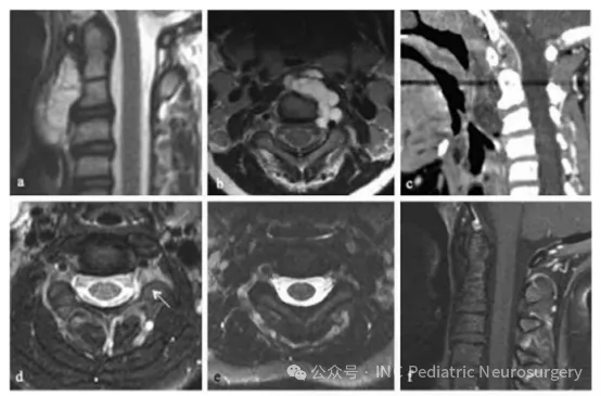 患者 4：C1–C3 脊索瘤影像示例 (a) 术前 矢状位T1 加权增强 MRI（gadolinium）； (b) 术前 轴位T1 加权增强 MRI； (c) 术前 矢状位CT； (d) 术后 轴位T1 加权增强 MRI，可见C2–C3 神经孔内小残余肿瘤（箭头）； (e) 放疗后 轴位T1 加权增强 MRI； (f) 放疗后 矢状位T1 加权增强 MRI。