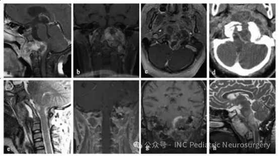 患者 5，巨大斜坡脊索瘤并脑干受压。 (a) 术前矢状位 T1 加权 MRI（增强）； (b) 术前冠状位 T1 加权 MRI（增强）； (c) 术前轴位 T1 加权 MRI（增强）； (d) 术前轴位 CT 扫描； (e) 术后矢状位 T1 加权 MRI（增强）； (f) 术后冠状位 T1 加权 MRI（增强）； (g) 术后 1 年冠状位 T1 加权 MRI（增强）； (h) 术后 1 年矢状位 T2 加权 MRI。