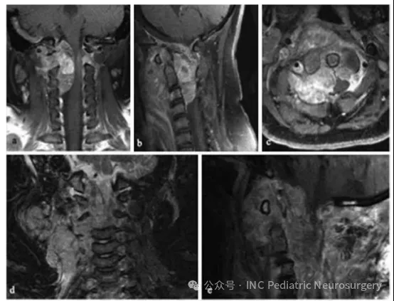 图 5. 患者 6 的 C1–C3 段脊索瘤 (a) 术前冠状位 T1 加权增强 MRI (b) 术前矢状位 T1 加权增强 MRI (c) 术前轴位 T1 加权增强 MRI (d) 术后 4 个月冠状位 T1 加权增强 MRI (e) 术后 4 个月矢状位 T1 加权增强 MRI