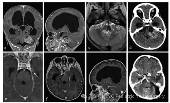 图6. 患者10的左桥小脑角区脊索瘤影像学随访资料。(a) 术前轴位T1加权钆增强MRI；(b) 术前矢状位T1加权钆增强MRI；(c) 术前轴位T2加权MRI；(d) 术前轴位CT扫描；(e) 术后5个月轴位T1加权钆增强MRI，显示左颞部新发硬膜病变（箭头）；(f) 术后9个月轴位T1加权钆增强MRI；(g) 术后9个月矢状位T1加权钆增强MRI；(h) 术后12个月轴位CT扫描。