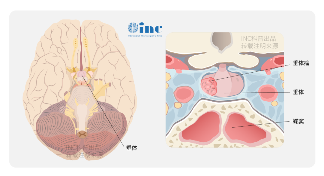 垂体瘤手术方式有哪些?分泌型垂体瘤内镜vs显微镜,谁主沉浮?