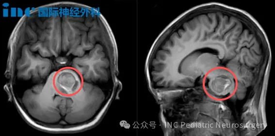 身为医者，这一次他要救的竟是脑干出血的女儿