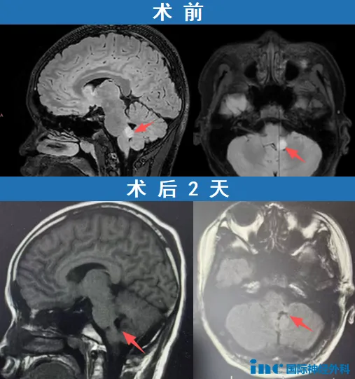 术前术后MRI对比
