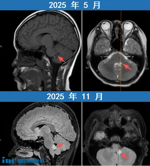 原先的病灶体积竟长了5mm，足足翻了一倍！
