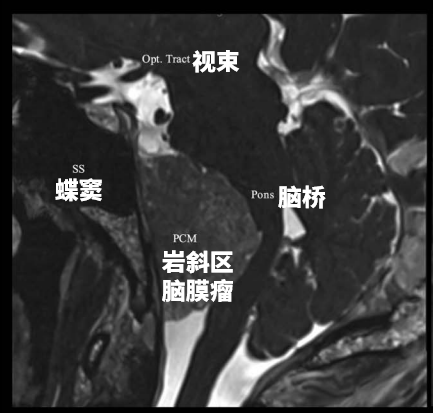 29×39×38 mm，一个大型岩斜区脑膜瘤像一个小山丘一样，山顶直接挤压“生命禁区”脑干，还与神经血管结构紧密粘连。