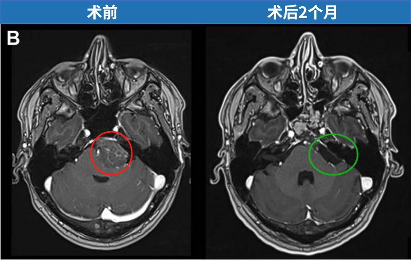 在INC福教授的定制化手术策略之下，无需开颅，仅右侧单鼻孔入路便全切肿瘤。