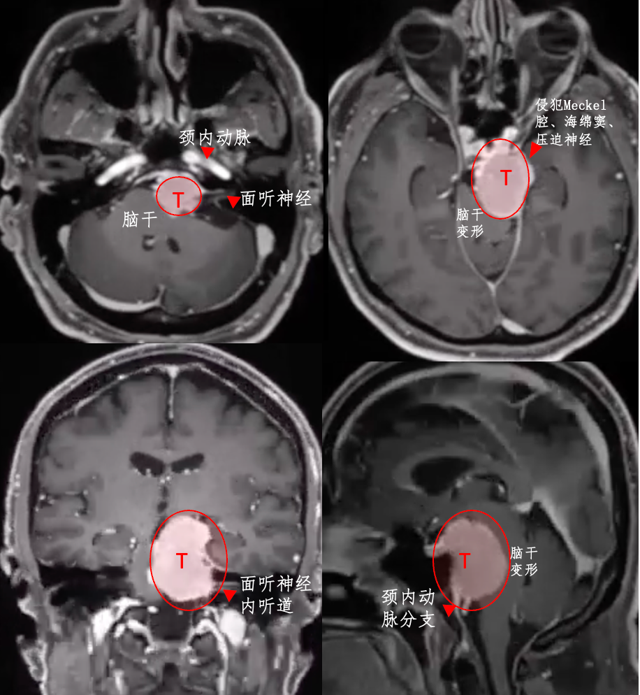 福教授采用开颅手术，术前通过线圈在咽升动脉处进行栓塞，可以显著减少术中出血。