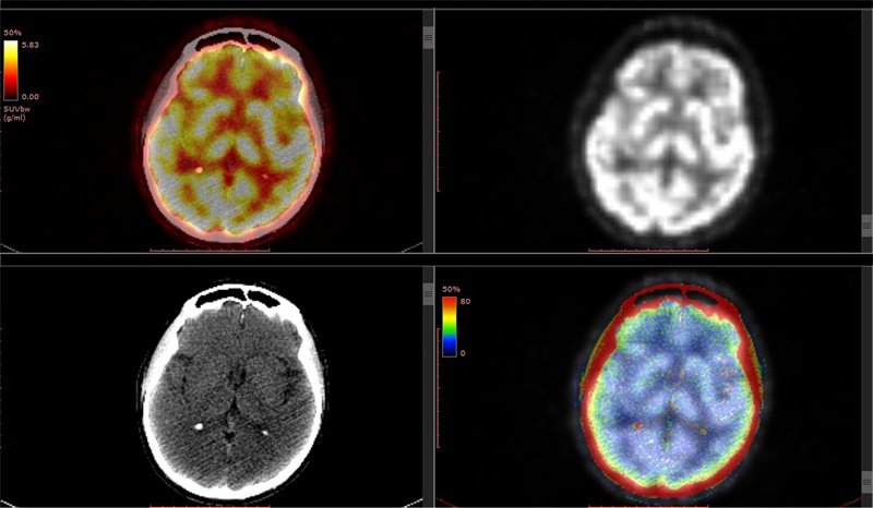 儿童中枢神经系统生殖细胞肿瘤：诊疗与预后