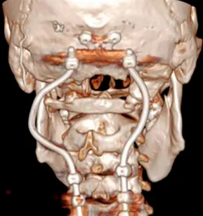 颅底手术  定制化    切除<a href='/naoliu/' target='_blank'><u>脑肿瘤</u></a>