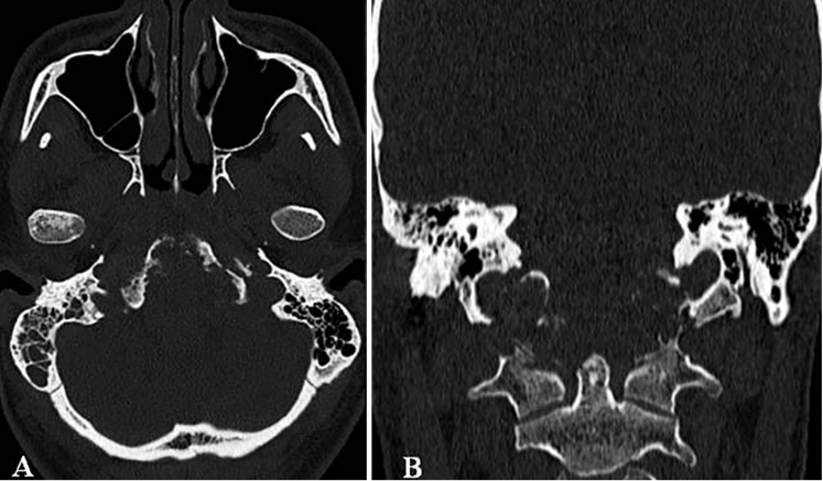 术前CT：显示颅颈交接区脊索瘤，侵犯斜坡-枕髁并呈溶骨性破坏。