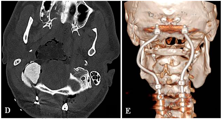 D:术后CT显示PMMA枕髁重建稳定良好。E:术后三维CT显示 C0-C3-C4-C5枕颈融合稳定，与根钉弯曲有利于PBRT治疗。