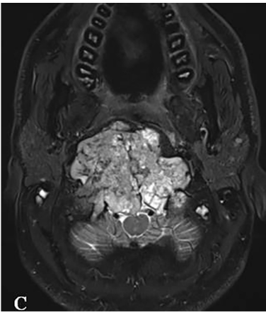 C:术前MR显示肿瘤巨大延伸，并浸润长入硬膜内的脑实质