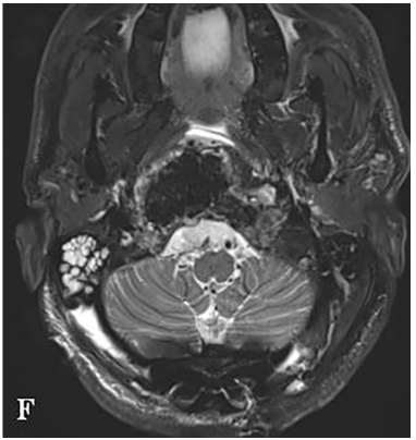 F:术后MR显示全切肿瘤和脑干延髓占位压迫得到解除。
