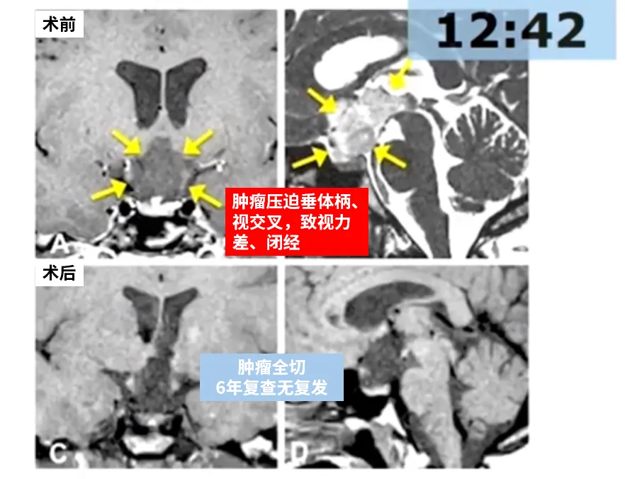 术后MRI证实全切（图C、D），术后病理显示毛细胞星形细胞瘤。
