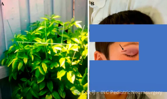 男孩遭铁杆刺入颅脑引发脑出血，未曾开颅，18个月后竟奇迹康复