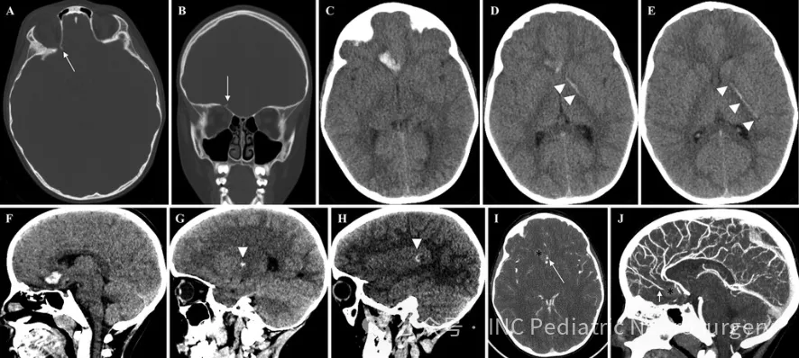 影像学检查显示,杰克的右侧额叶存在脑实质出血,并向左顶叶延伸,经过胼胝体膝部、左侧苍白球、内囊前肢和左侧后部岛叶,同时伴有右侧眶顶骨折和局灶性蛛网膜下腔出血。