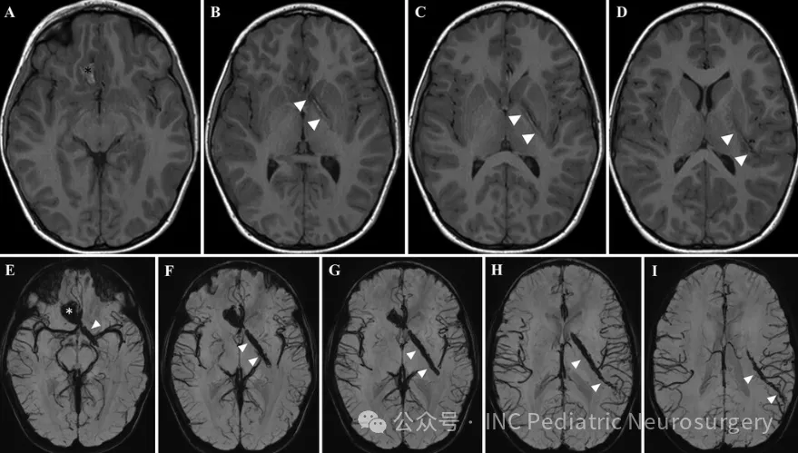 尽管尖端从右侧眼眶上方穿过眼球顶部,刺入颅内,且穿过骨性眶顶,但却十分“巧合”地避开了大脑前动脉,勉强避开了内囊后肢,最终停在对侧的左侧颞上回。