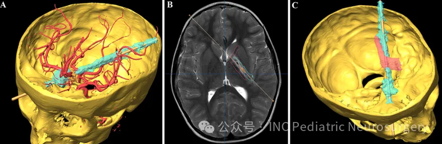 下图为患者头骨及损伤轨迹的三维(3D)重建
