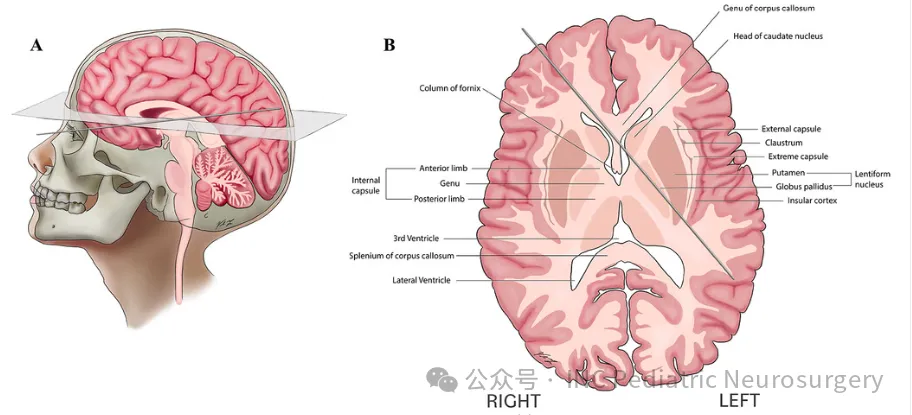 下图为尖端通过右侧眼眶进入颅骨的轨迹(A)及其与脑实质内功能结构的解剖关系(B)