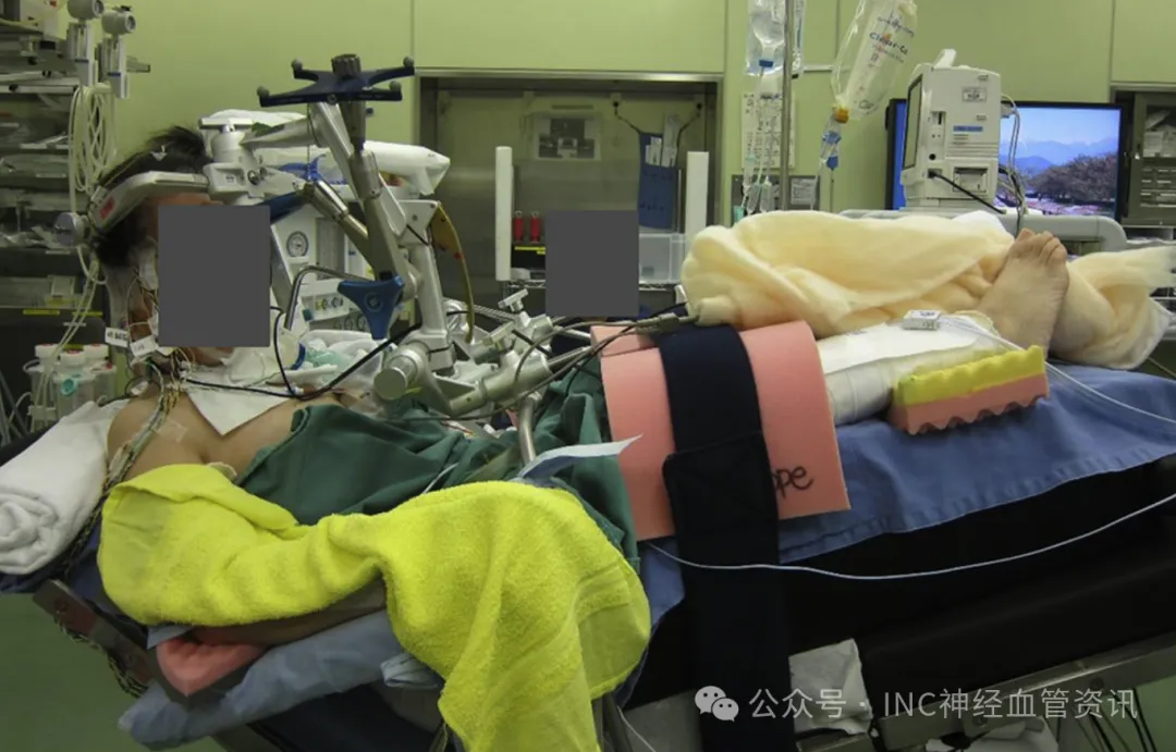 患者以半坐姿接受治疗。髋关节最多弯曲90度，双腿抬高，脚趾位于头顶附近。上半身尽可能向后倾斜，头部向前弯曲。