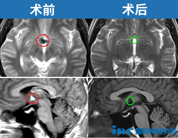 术前术后MRI对比