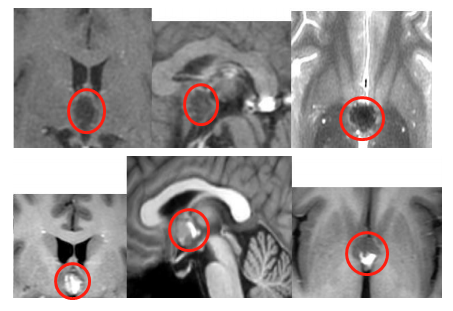 就医头颅核磁检查后考虑第三脑室病变，疑似海绵状血管瘤，约14×13×10mm大小。