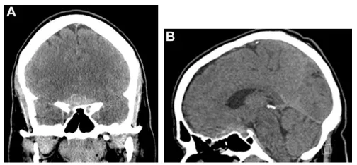 图1. （A、B）冠状位及矢状位平扫CT显示鞍上区高密度占位性病变，沿蝶骨平台向前延伸。