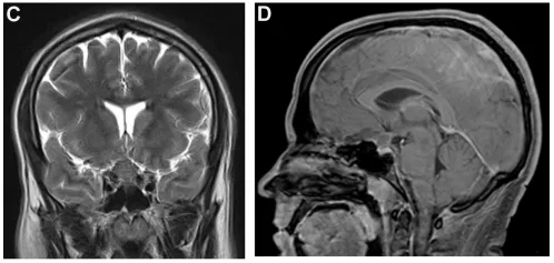 （C、D）冠状位及矢状位磁共振成像（MRI）提示视交叉旁非强化性、轴外斑块状4cm占位，压迫垂体柄及垂体腺。