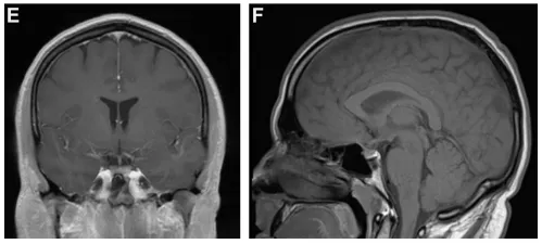 （E、F）4周后随访MRI冠状位及矢状位扫描显示原蝶骨平台及鞍上占位病变接近完全消失。