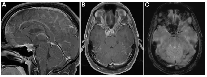 图2. （A、B）矢状位及轴位T1加权增强MRI显示鞍区及鞍上占位复发，与垂体腺分界不清，病灶再次沿蝶骨平台及斜坡颅侧延伸。（C）梯度回波序列显示病灶呈显著磁敏感效应，并新出现强化灶。