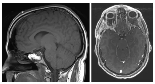 图3. （左）矢状位T1加权及（右）轴位T1加权增强MRI显示病变全切除，未见残留病灶。
