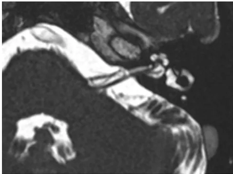 MRI(磁共振):检查发现,在患侧,小脑前下动脉(AICA)的血管袢正压迫着他的前庭耳蜗神经(负责听力和平衡的神经)。