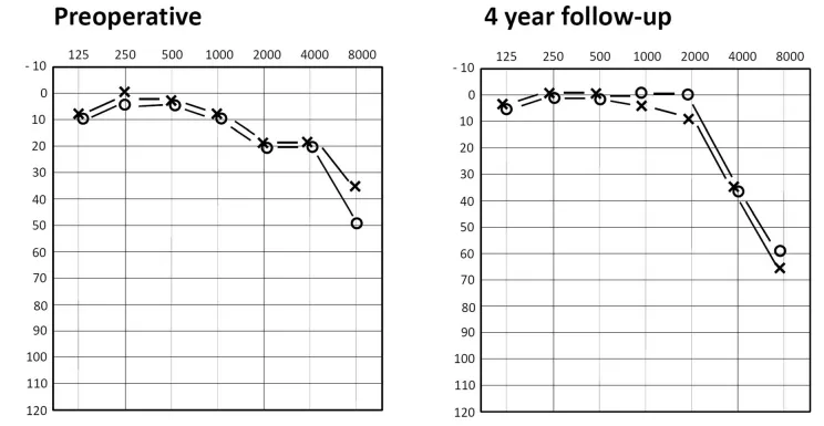 图4:术前(左图)与术后4年随访(右图)听力图对比。