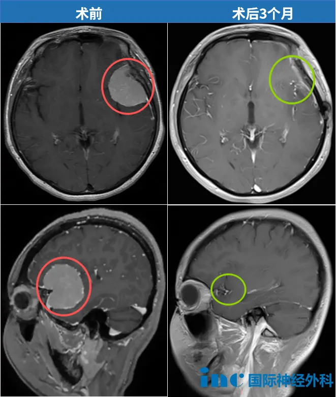 术前术后MRI对比