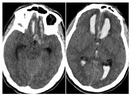图1:前交通动脉瘤破裂致广泛脑实质、蛛网膜下腔及脑室内出血的CT影像表现