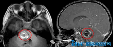 5岁男孩脑干出血“不治而愈”，好运气为何却令他深陷险境？