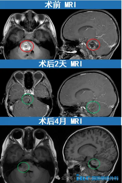 淼淼已经顺利出院，在术后第4个月与第6个月随访时，孩子的状态已与常人无异
